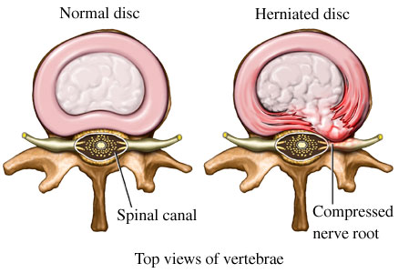 Disc bulge impinging upon spinal nerve root. 