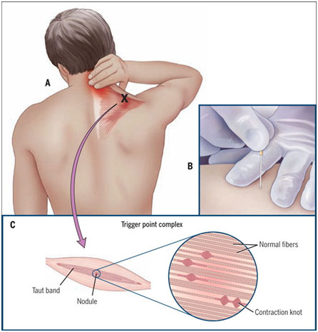 dry-needling-1.jpg
