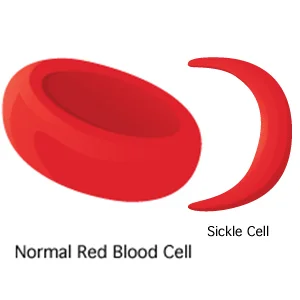 Gene Therapy For Sickle Cell Disease Passes Key Preclinical Test