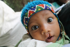 Operation Smile