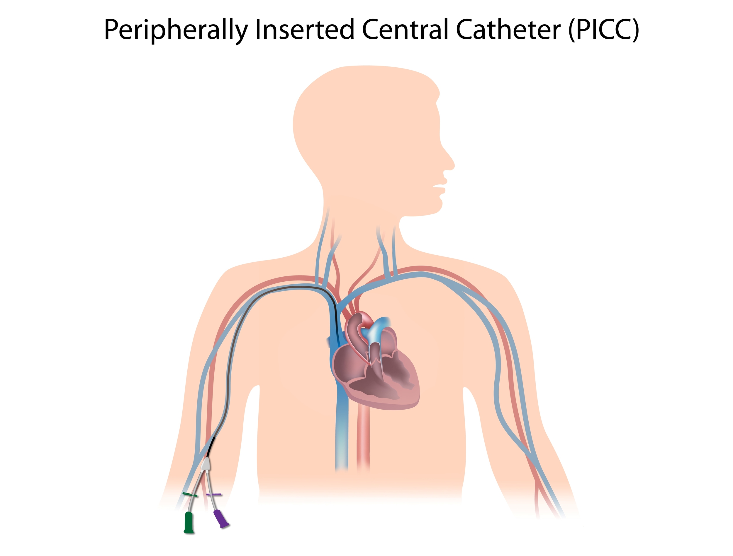 Central Line Insertion — From New to ICU