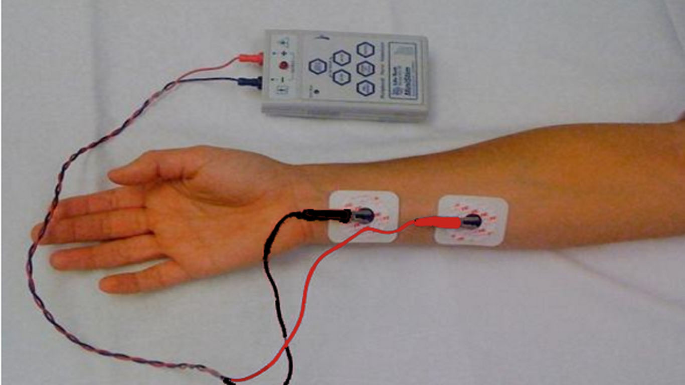 Peripheral Nerve Stimulator - Train of Four Monitoring: Overview,  Periprocedural Care, Technique