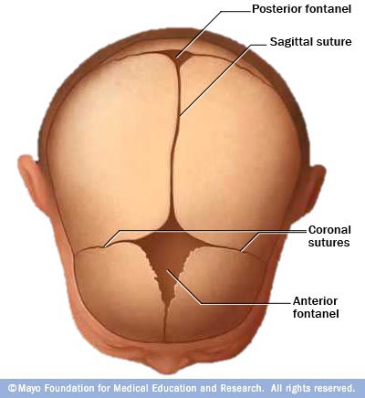 Craniosynostosis.jpg