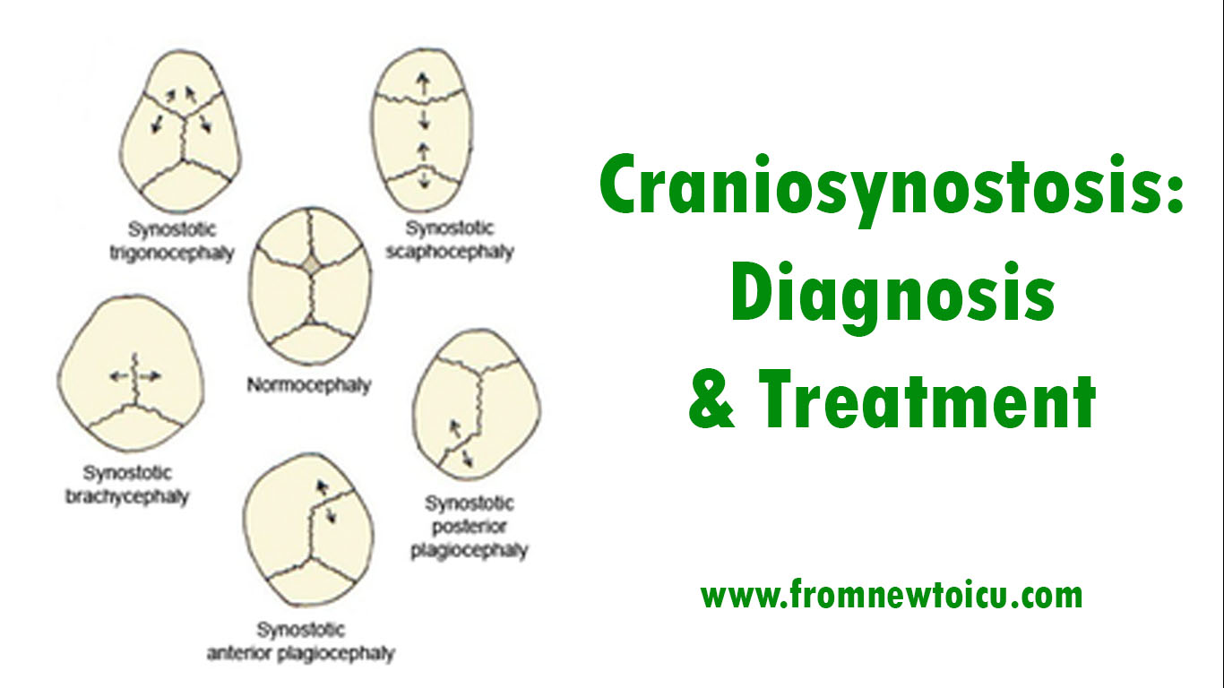 Craniosynostosis.jpg