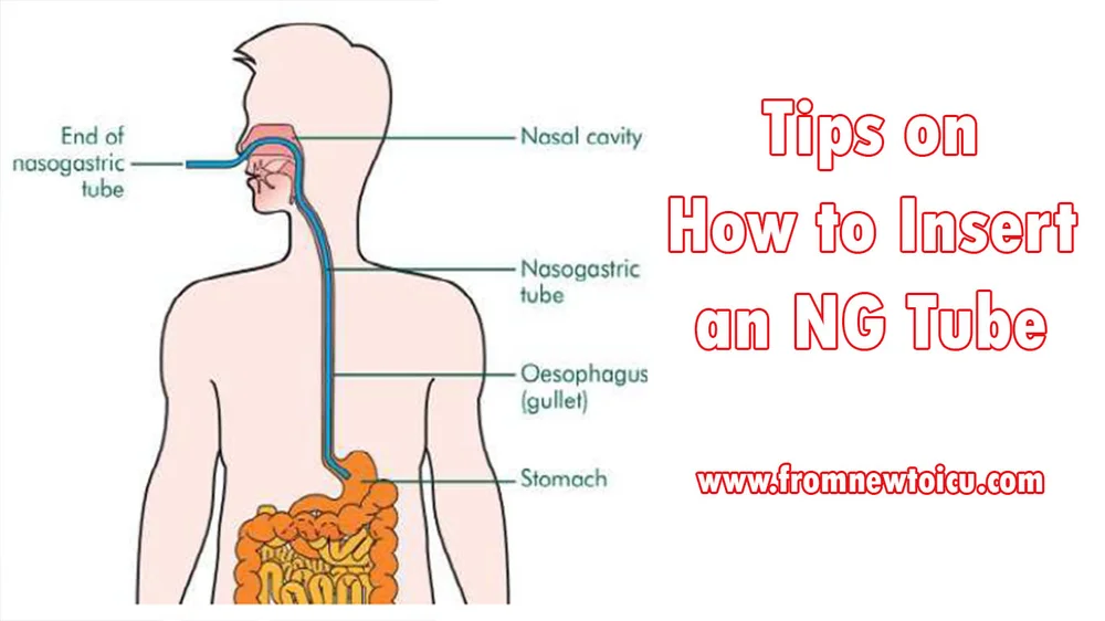 How To Insert An Ng Tube From New To Icu