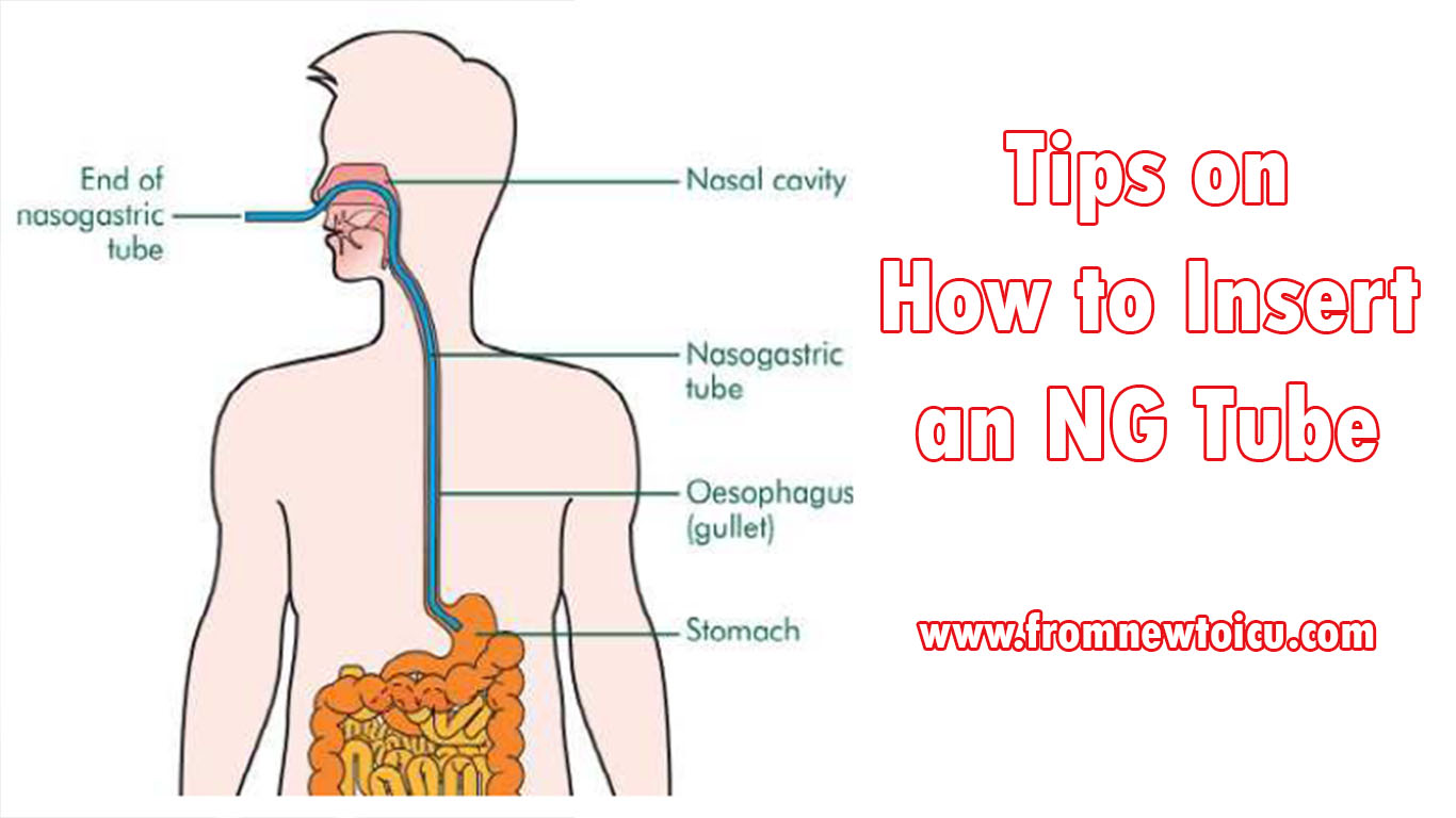 Ng tube insertion