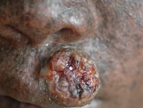 Squamous cell carcinoma of the upper lip. 