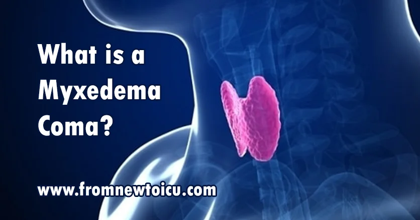 What Is A Myxedema Coma From New To Icu