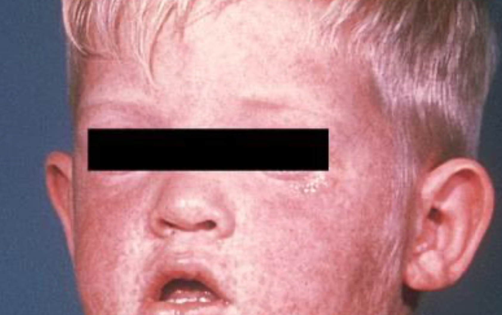 Alberta Records First Measles Death