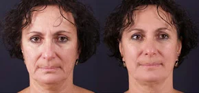 exilis-before&after-9.jpg