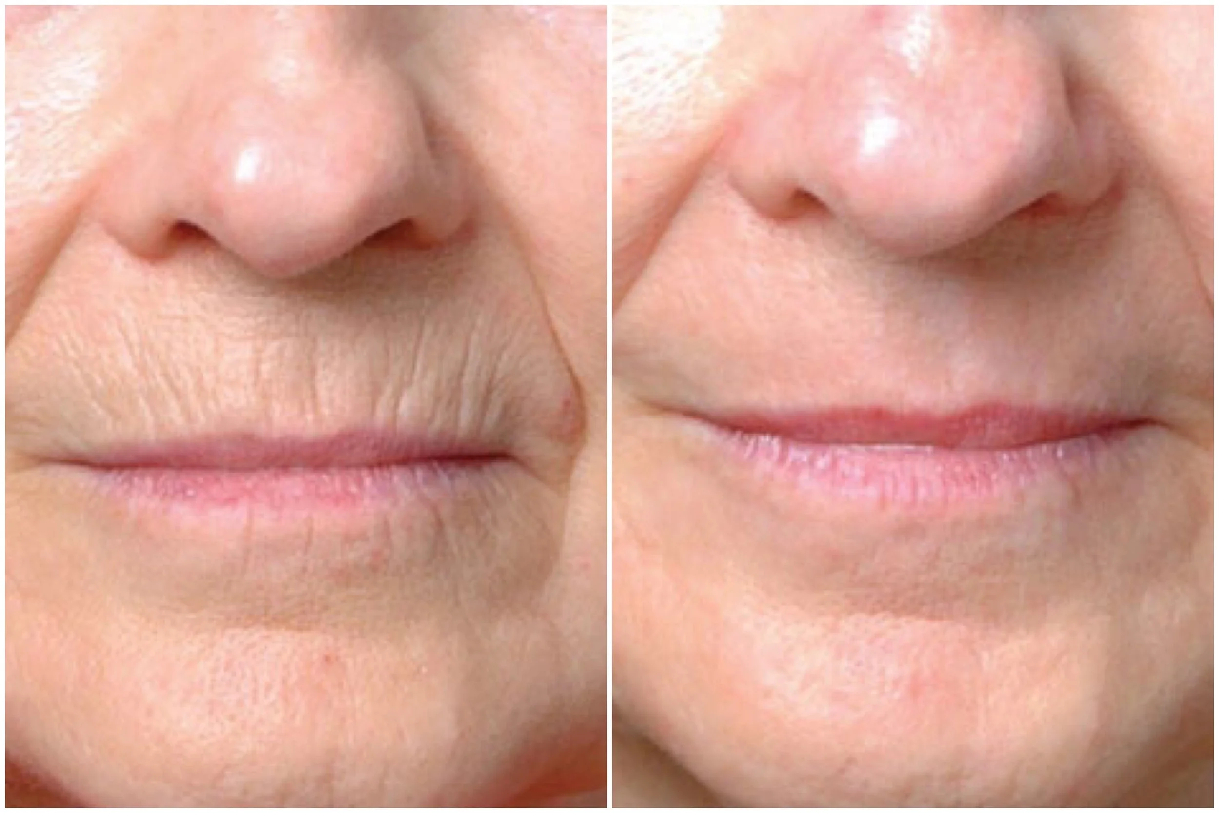 Before and 1 Month After Laser Resurfacing