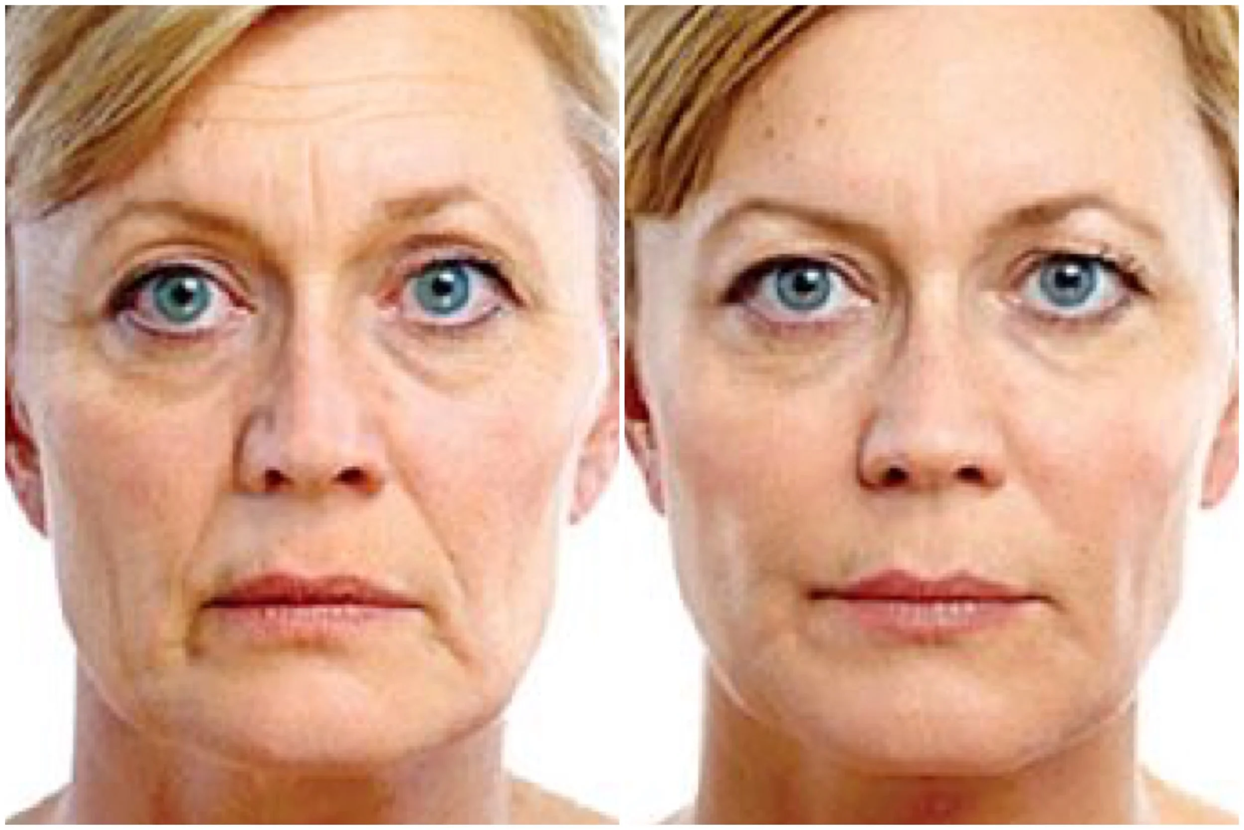 Exilis Skin Tightening Before and After , 3 Treatments