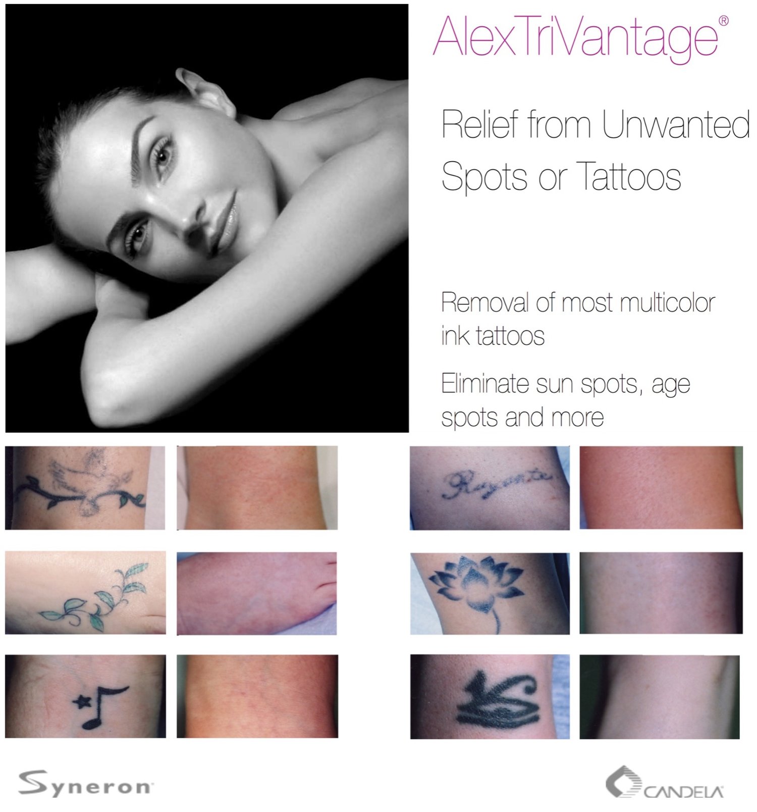 Laser Tattoo Removal — Central Kentucky Plastic Surgery