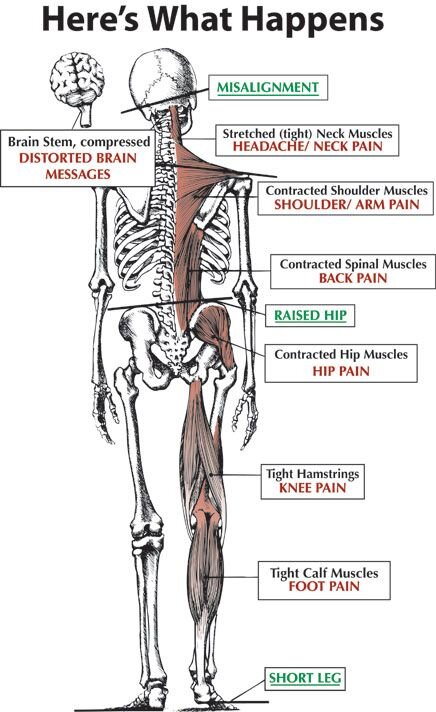 Connection Between a Short Leg and Upper Cervical Chiropractic