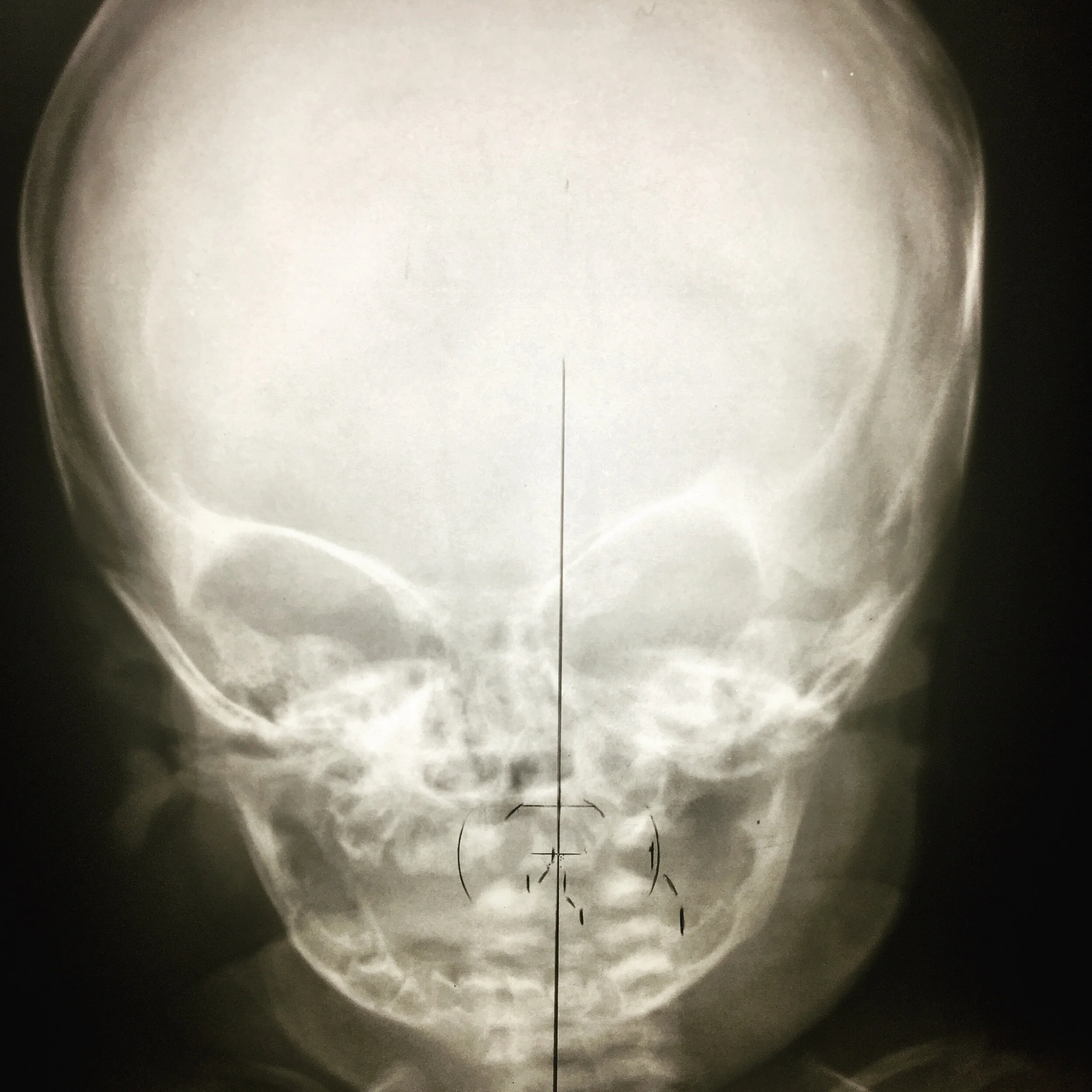 100+ Years of Pediatric Spinography
