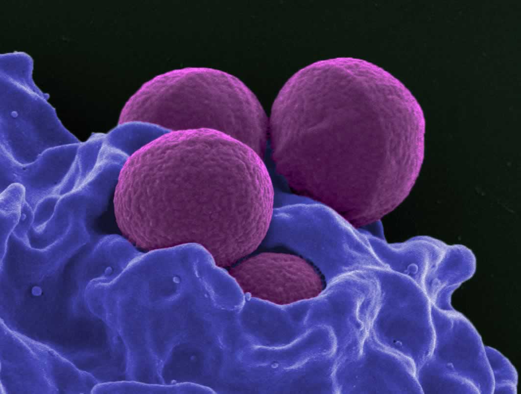 Superbugs