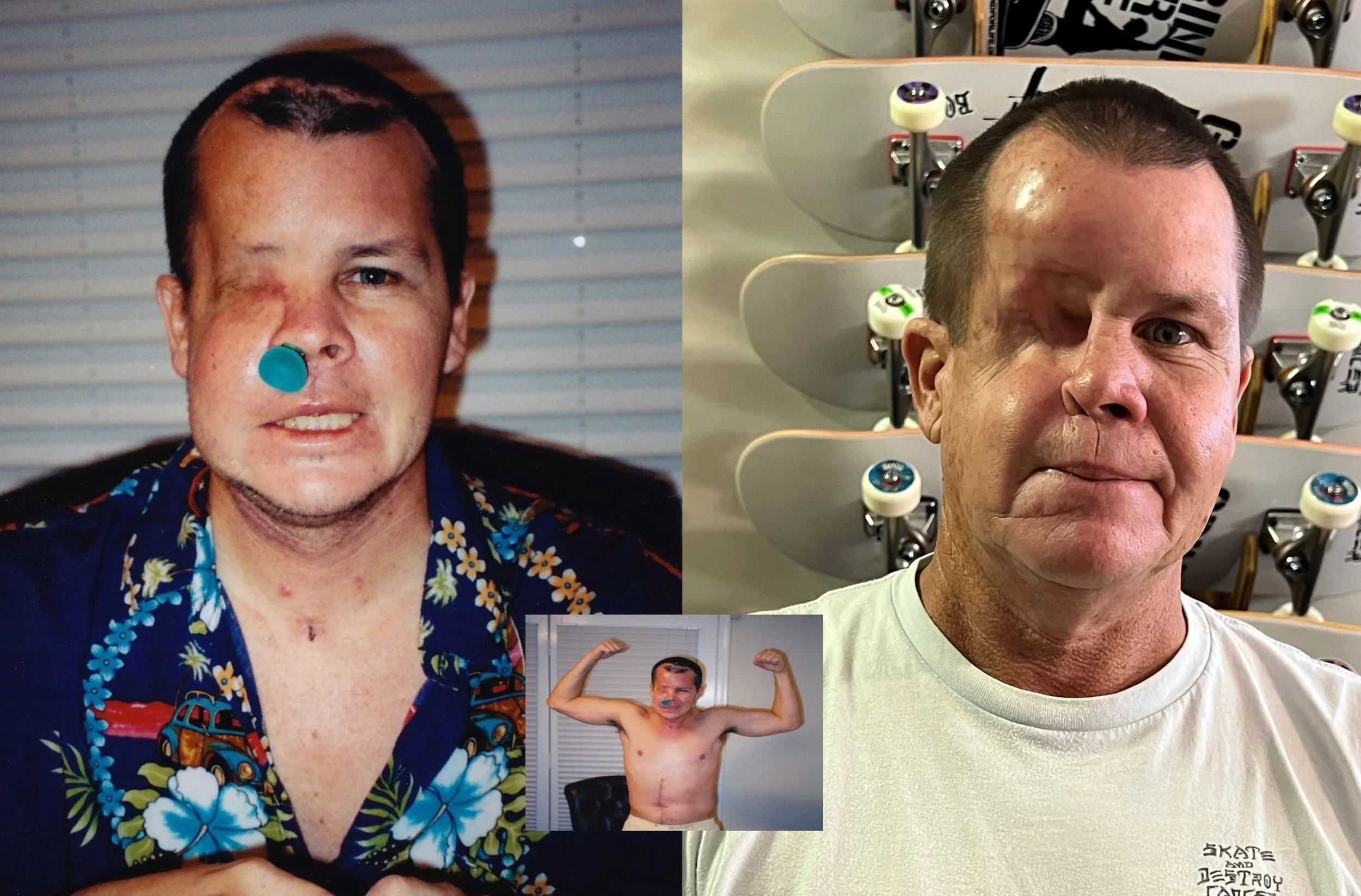 19 Years Cancer Free in 2022 