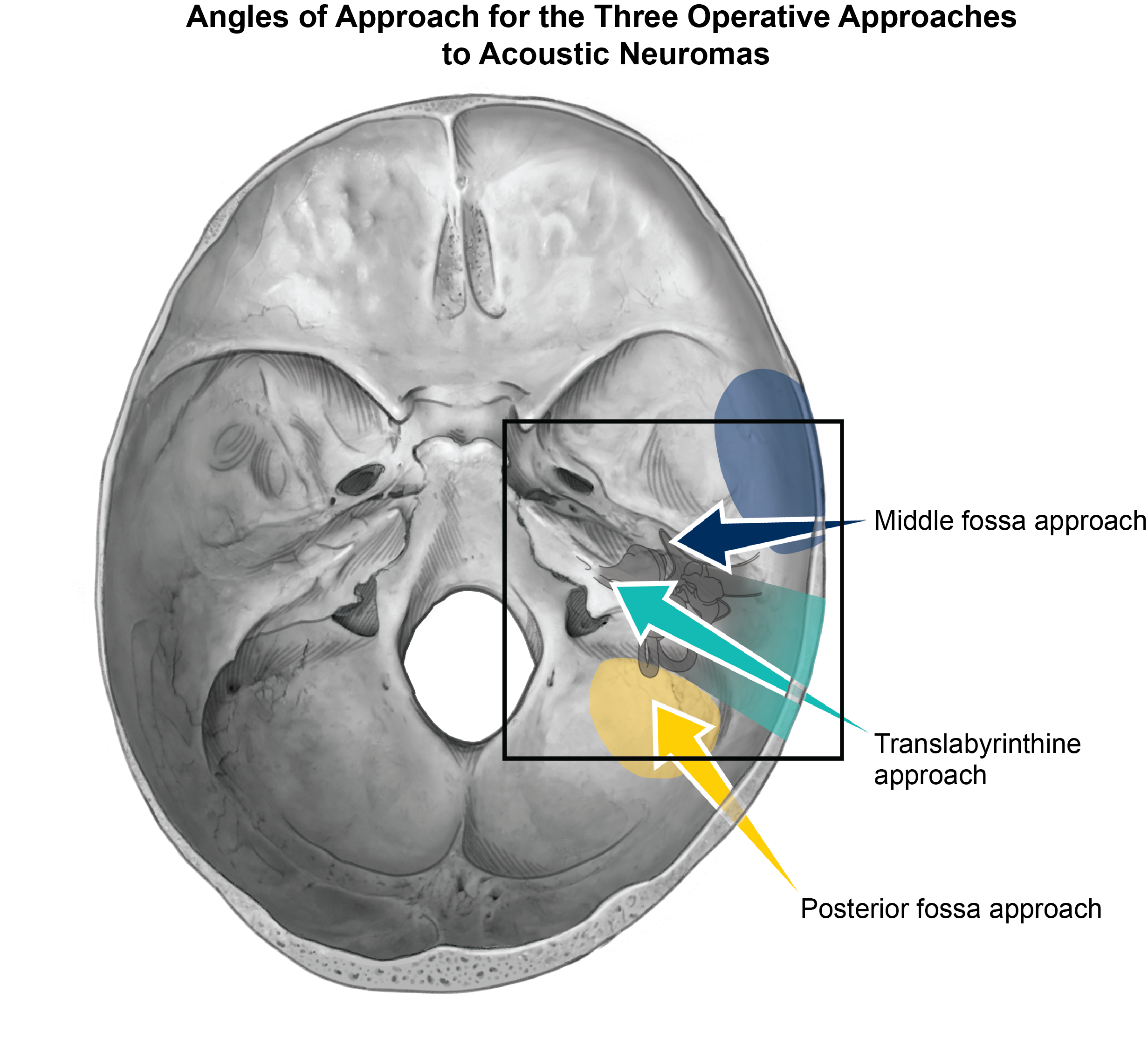 acoustic_neuroma_approaches(labeled).png