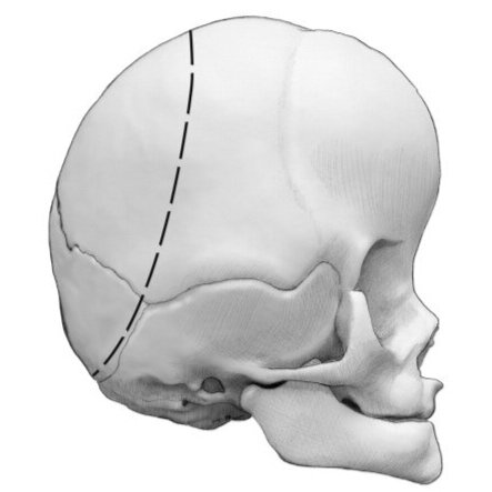 cranial_vault_deformity_surgery.jpg