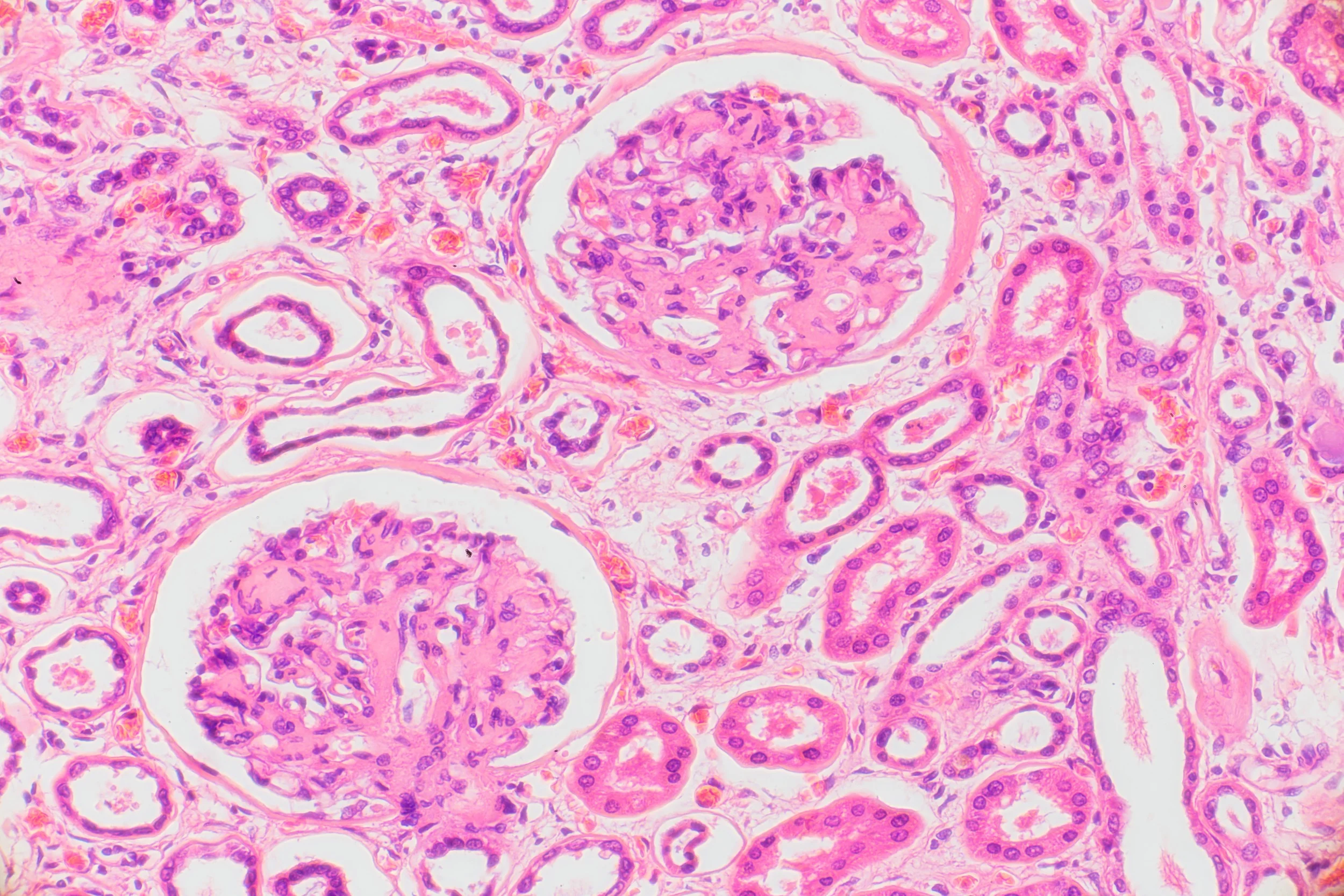  Two Bowman's Capsules within a diabetic kidney section&nbsp;  64x magnification  2015 
