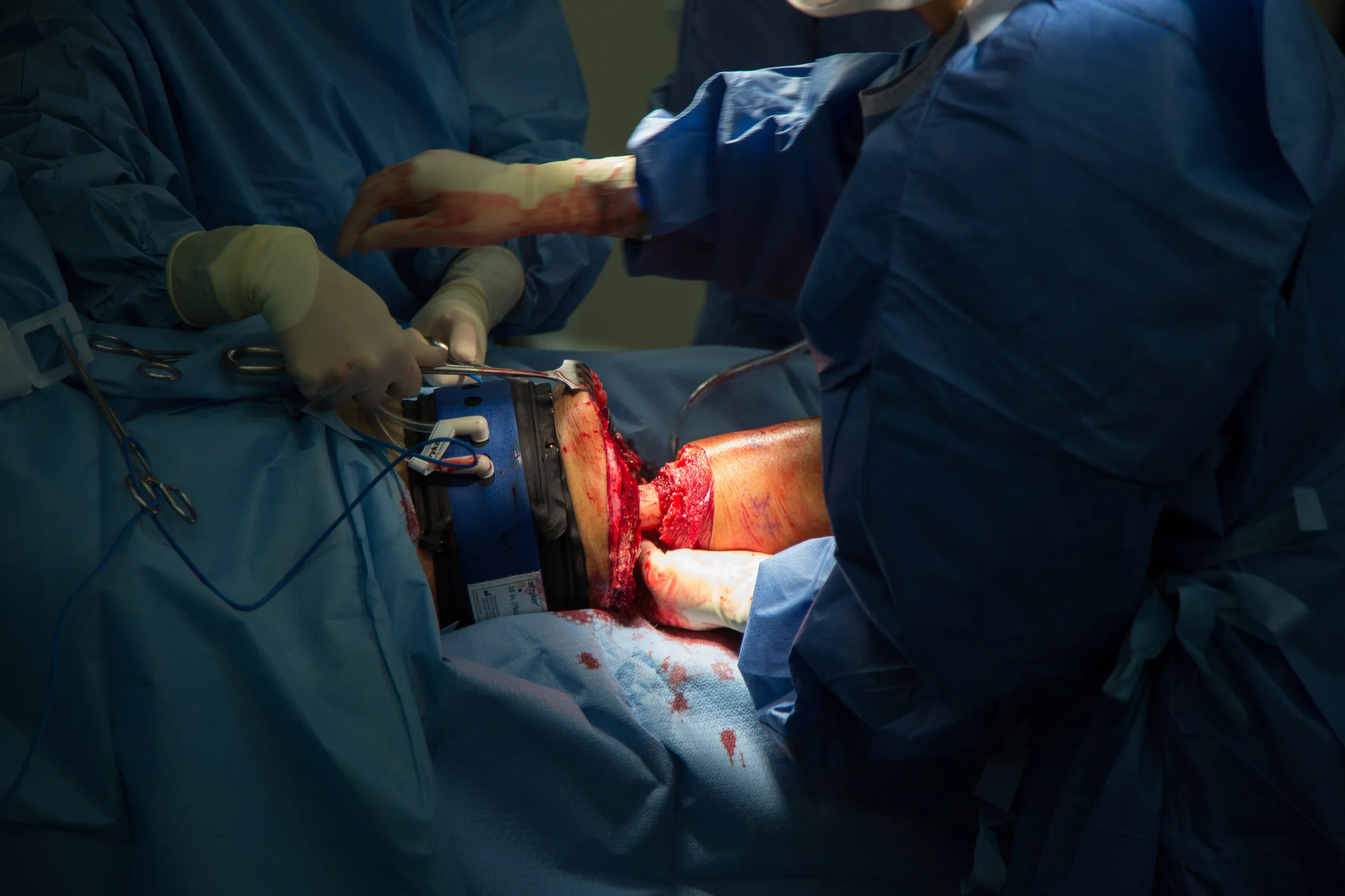  A surgeon prepares to cut through a patient's femur.&nbsp; 