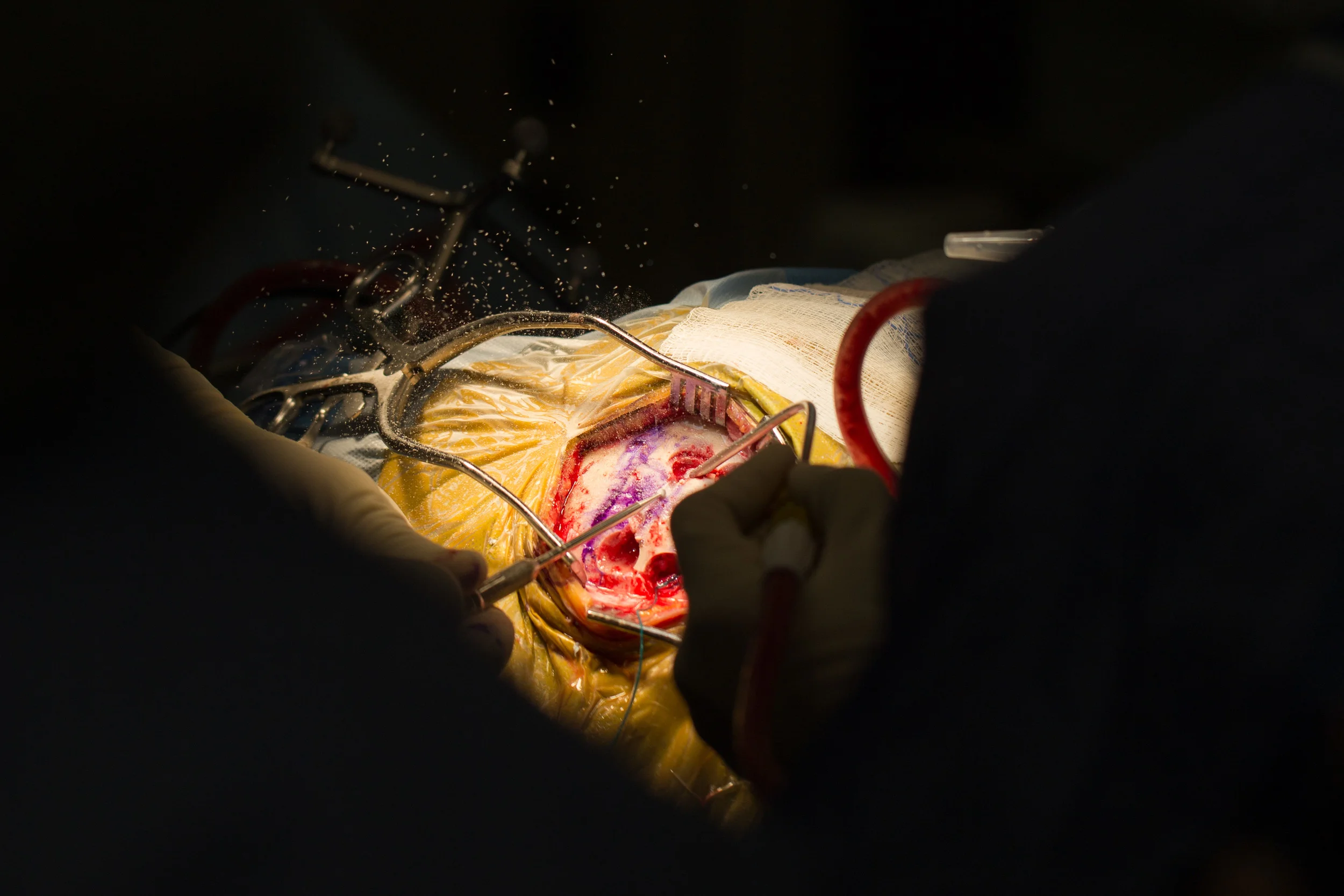  A small drill is used to remove a piece of the skull.&nbsp; 