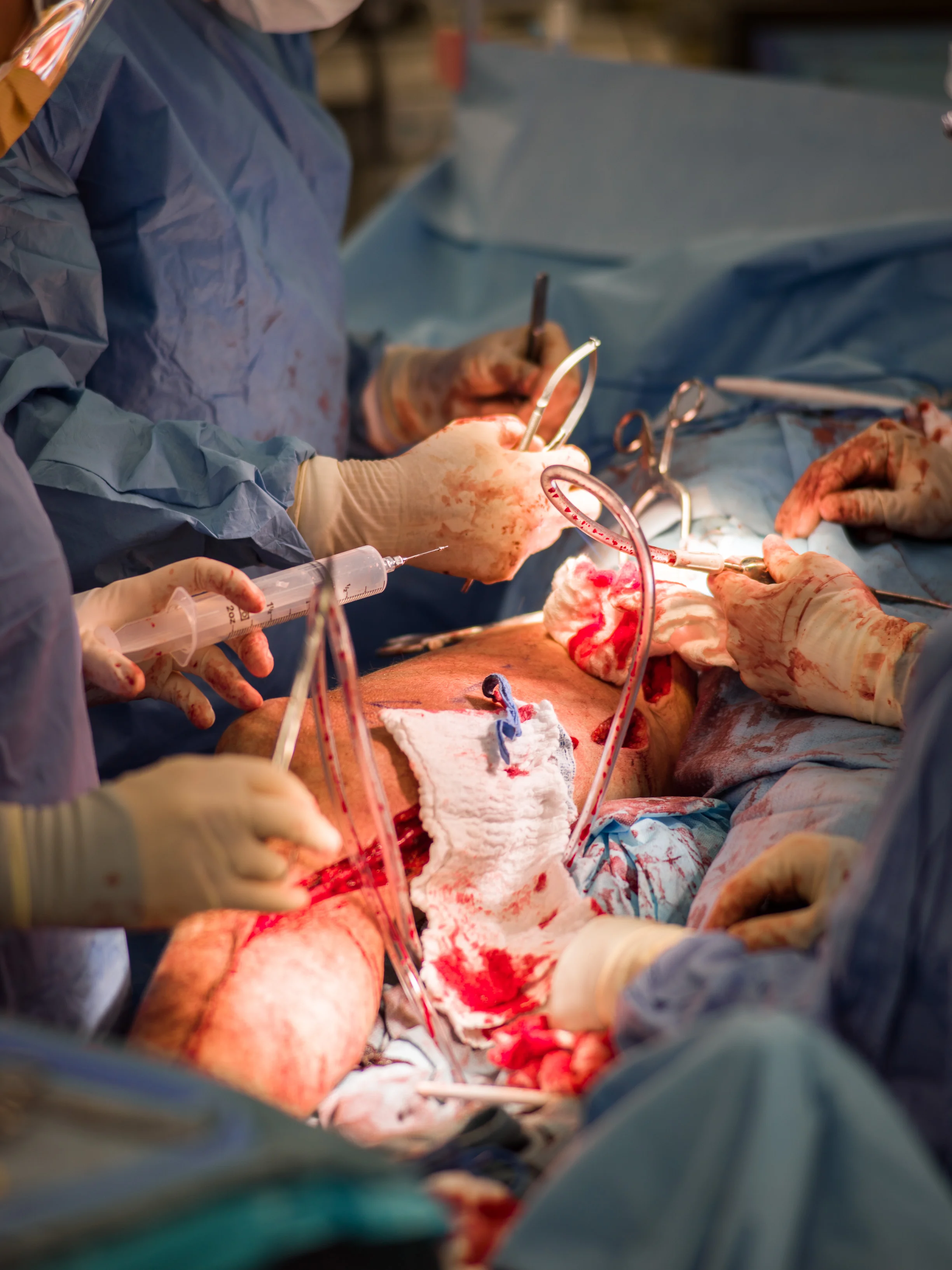  The surgical team performs a femoral artery bypass.&nbsp; 