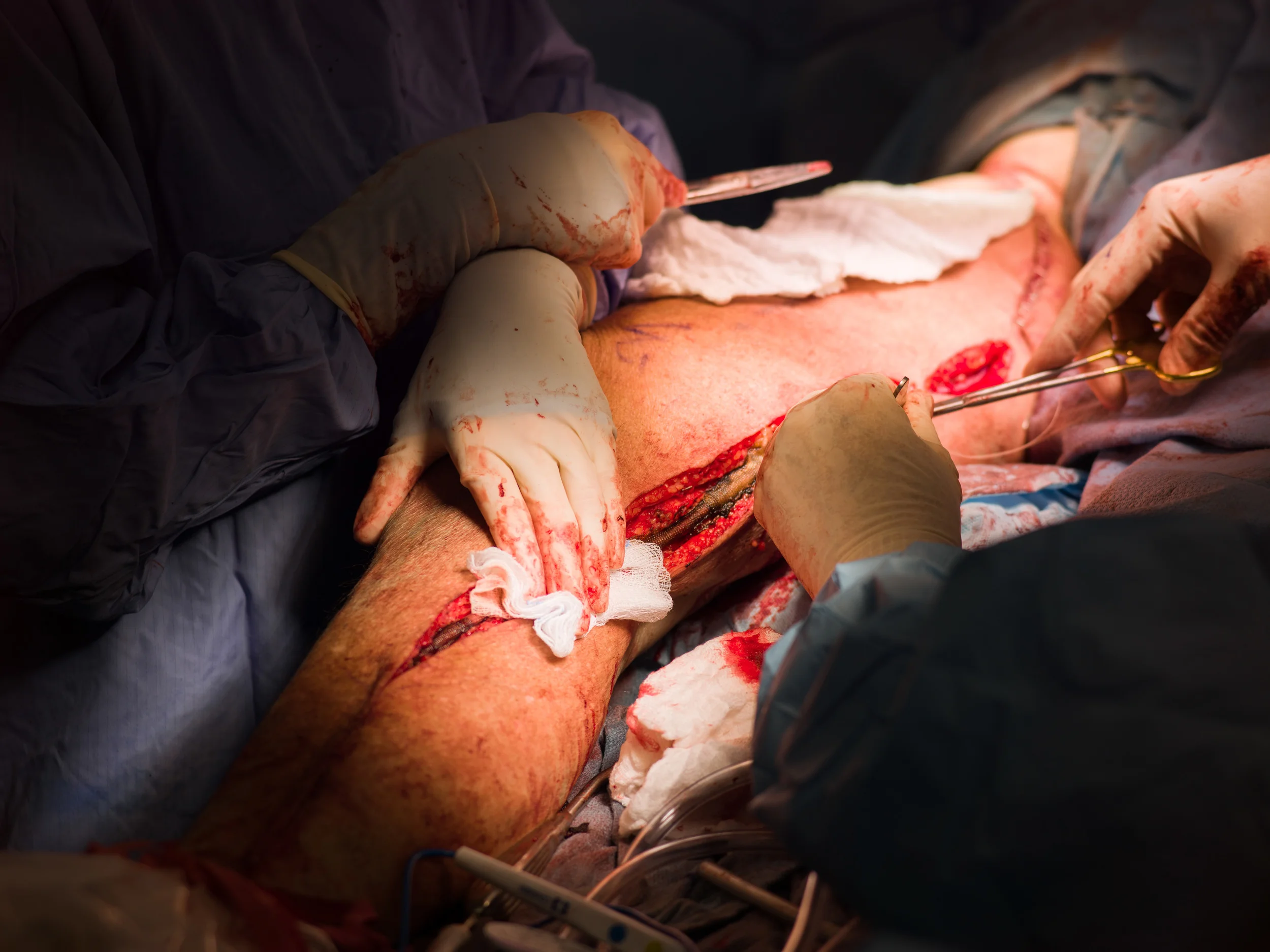  The team places a graft in the femoral artery of a patient.&nbsp; 