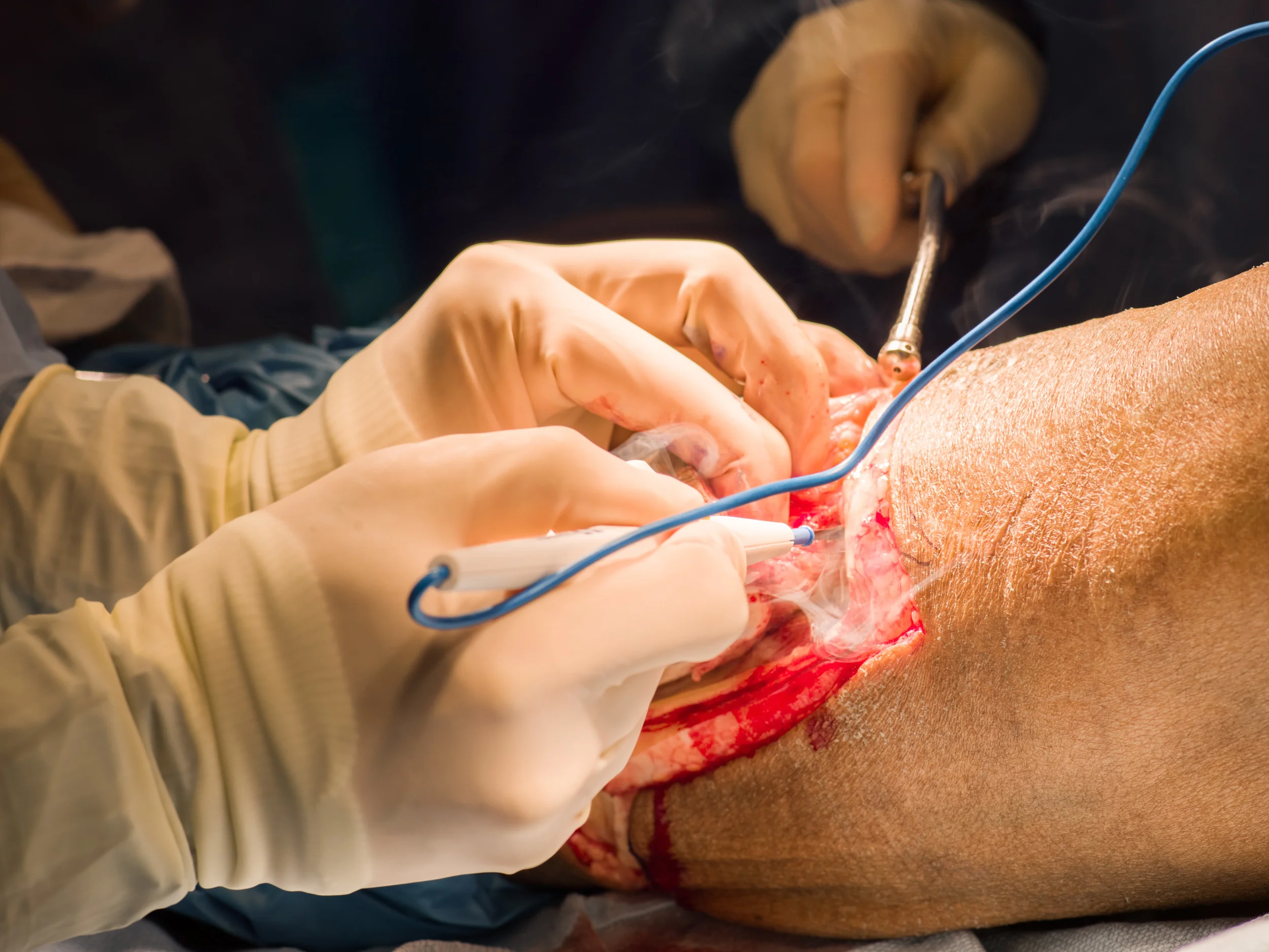  A surgeon cauterizes an incision before a leg amputation.&nbsp; 