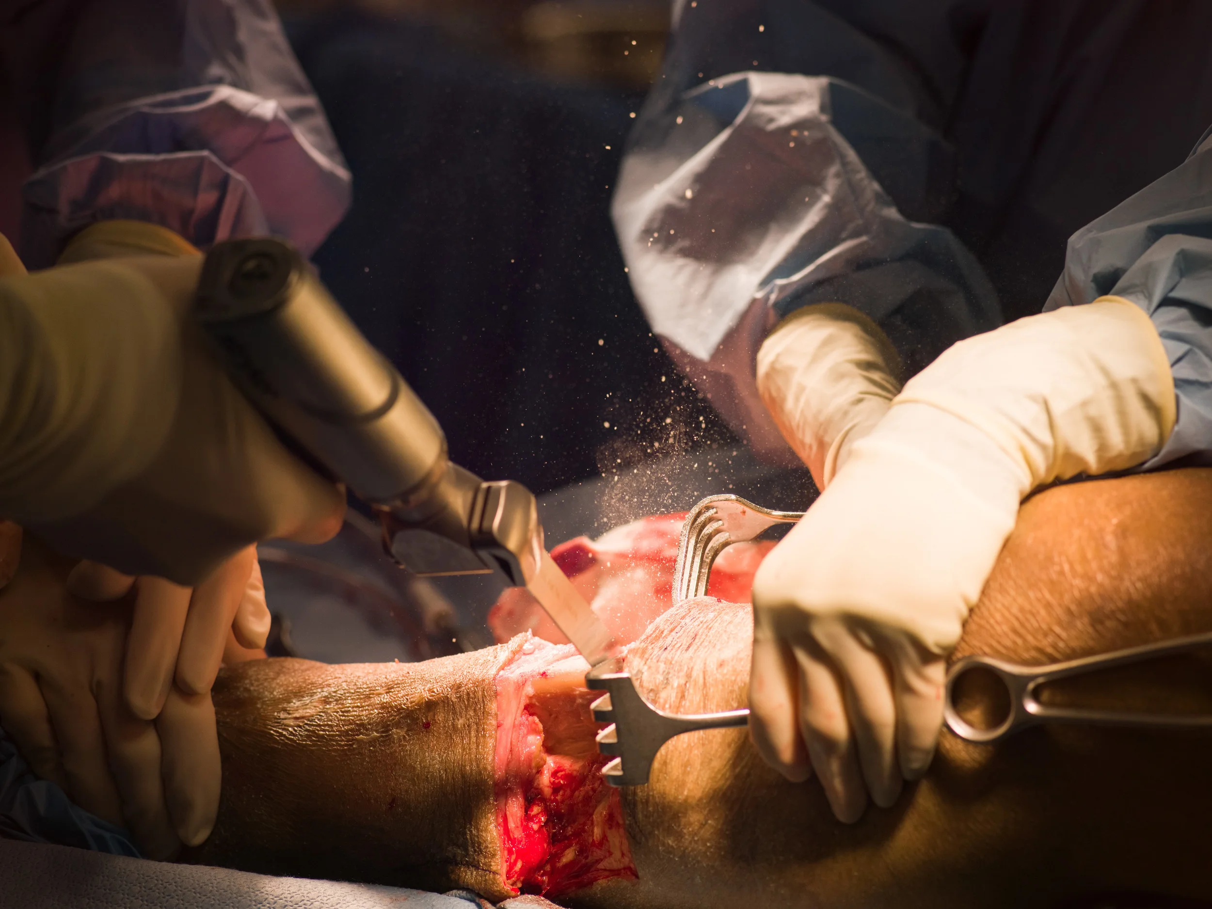  The tibia is severed by a reciprocating saw.&nbsp; 