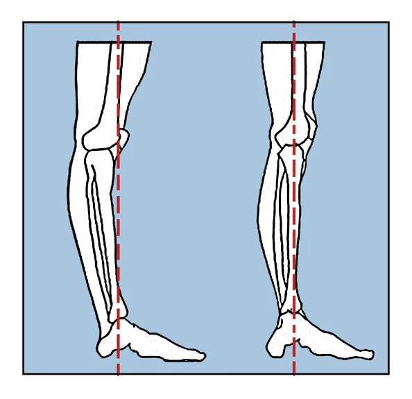 L: Hyperextension R: Normal knee