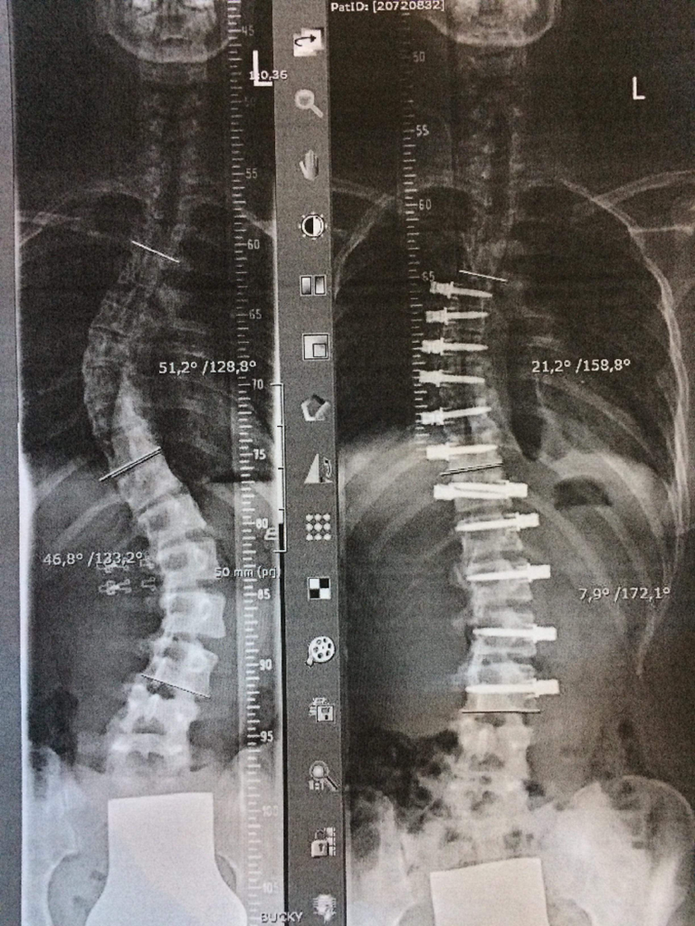 Devon's spine pre-surgery on the left, both curves measuring at around 50 degrees. Post-surgery, on the right, you can see the screws in place along the spine, with her curves measuring around 22 and 8 degrees. This has now settled down to around 23 and 14 degrees post recovery, as everything has found a new alignment.