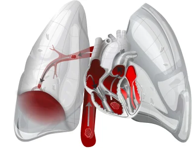 lungs_pulmonary_embolism.jpg