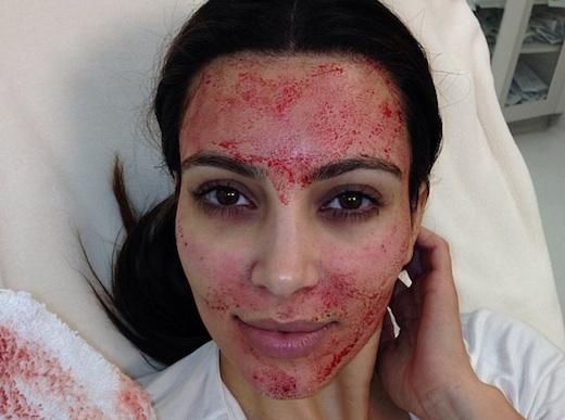 Vampiric Beauty Kim Kardashian shows off the effects of a "vampire facial" or "blood facial." Kim Kardashian on Instagram