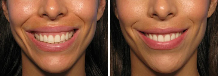 botox-smile.jpg