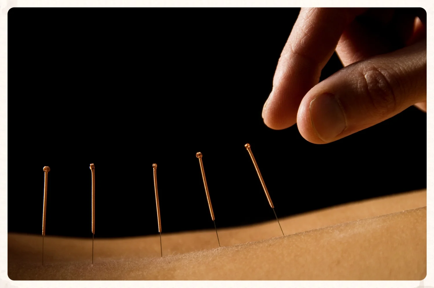 acupuncture 1.jpg