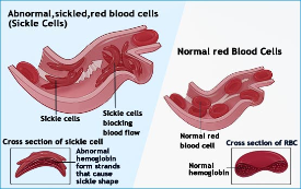 Visual of sickle shaped red blood cells.