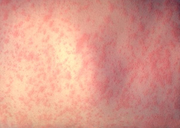 Skin of a patient after 3 days of measles infection. (Photo courtesy of CDC).