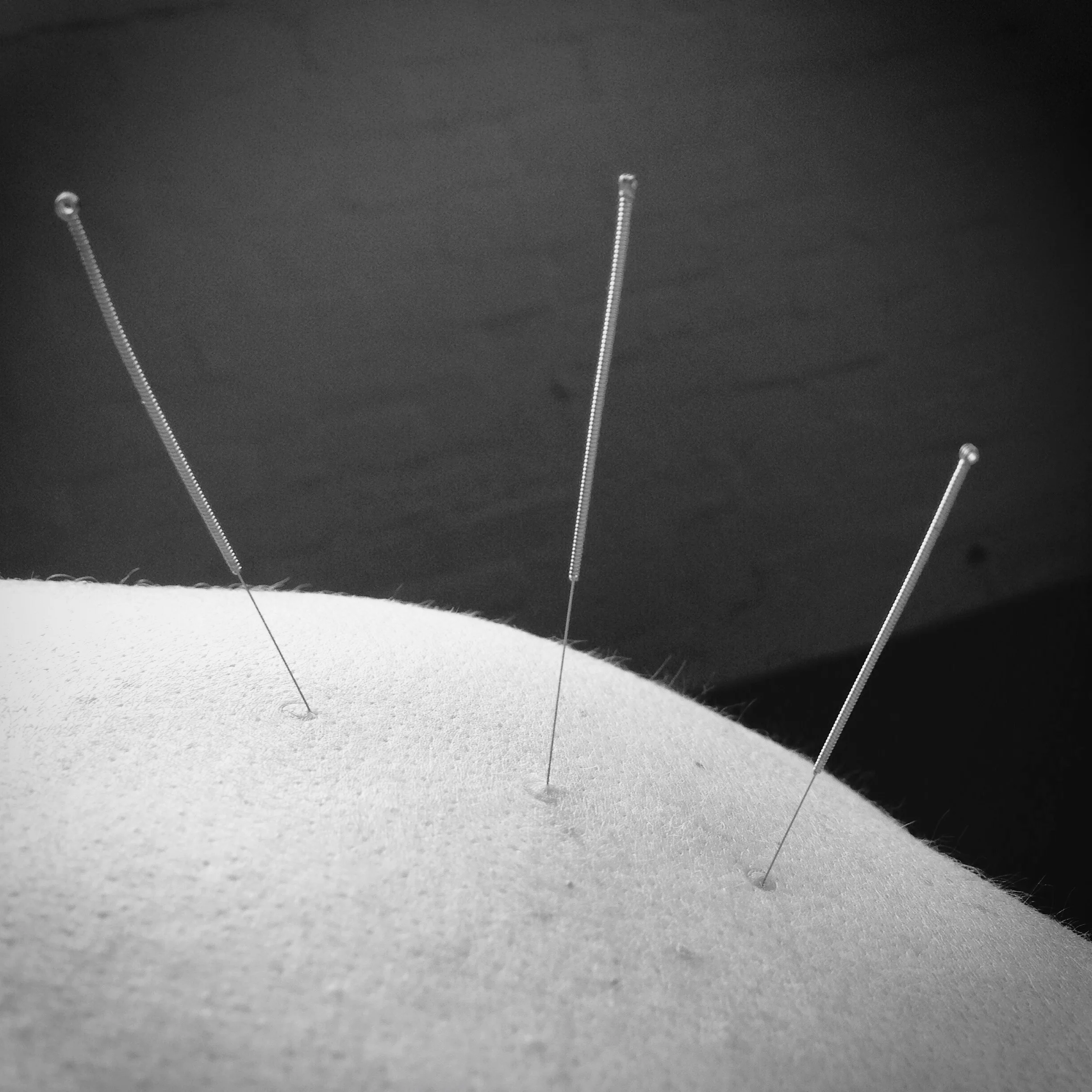 Dry Needling muscles through the back.