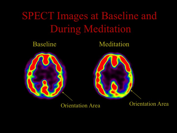  To look at the neurophysiology of religious and spiritual practices, we used a brain&nbsp;imaging technology called single photon emission computed tomography (SPECT), which allows us to measure blood flow. The more blood flow a brain area has, the 