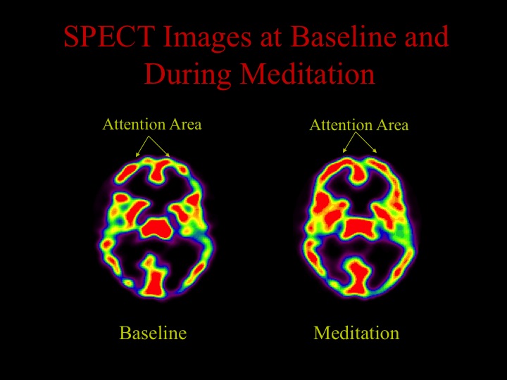  The front part of the brain, which is usually involved in focusing attention and concentration, is more active during meditation (increased red activity). &nbsp;This makes sense since meditation requires a high degree of concentration. We also found