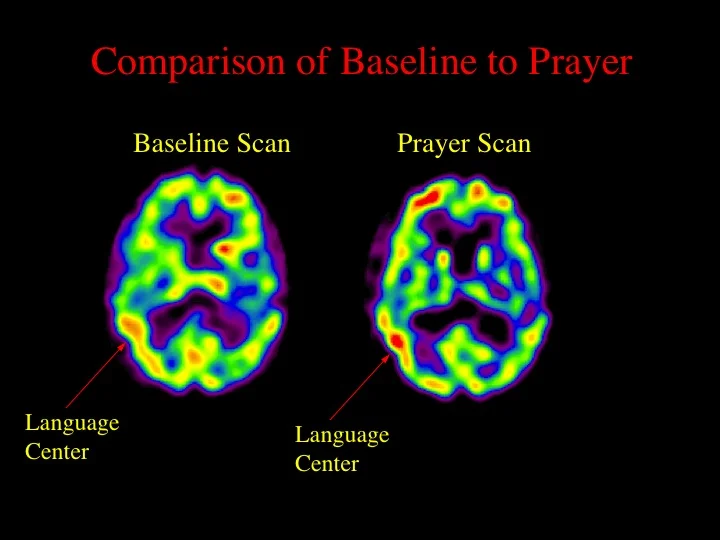 Spect Brain