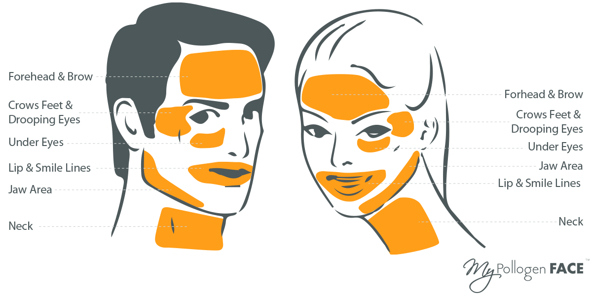 LipofirmPro-face-treatment-areas.png