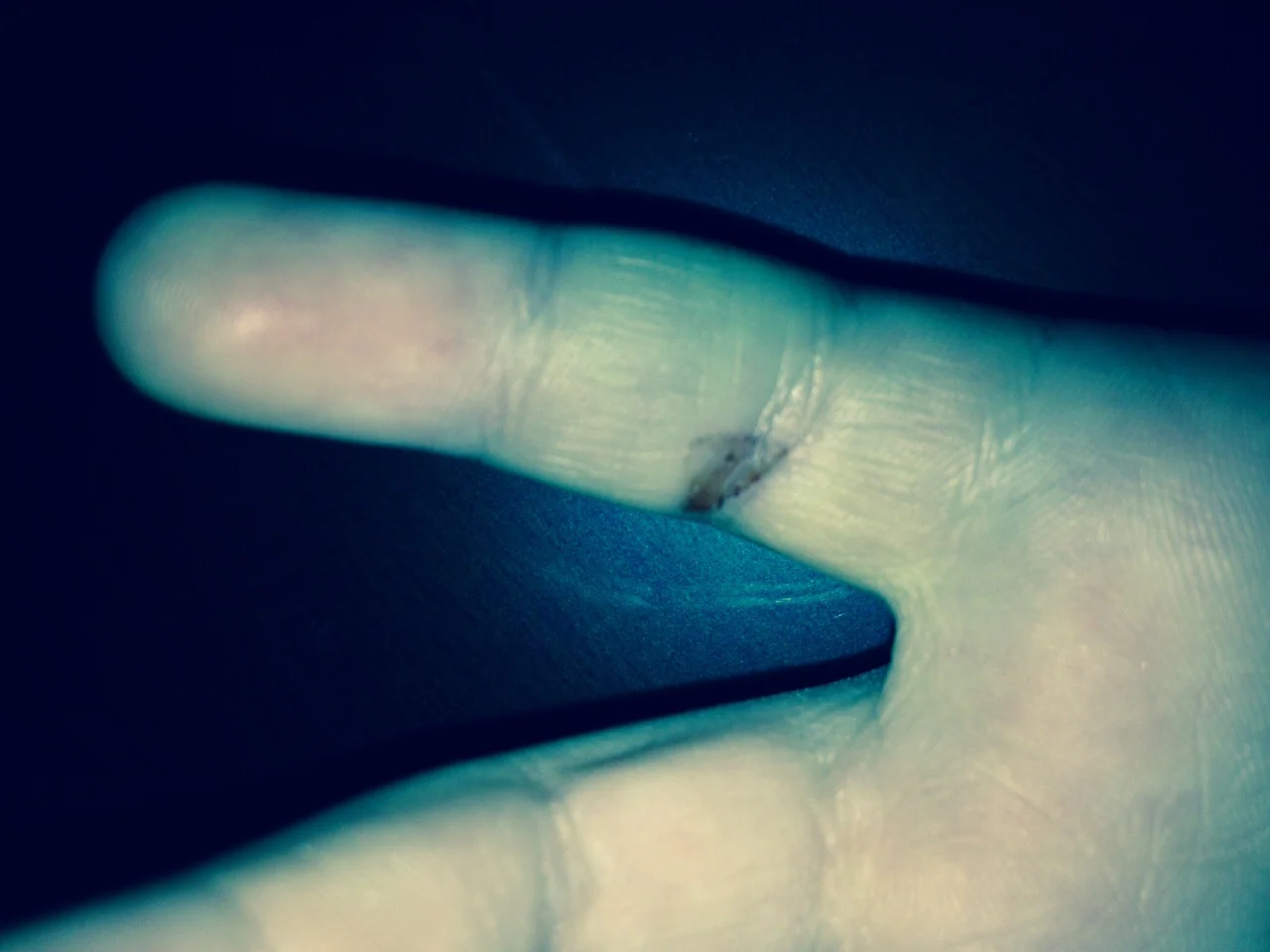 The pinky after a couple of days. The swelling went down and just FYI, there was never any 'gushing' blood. 