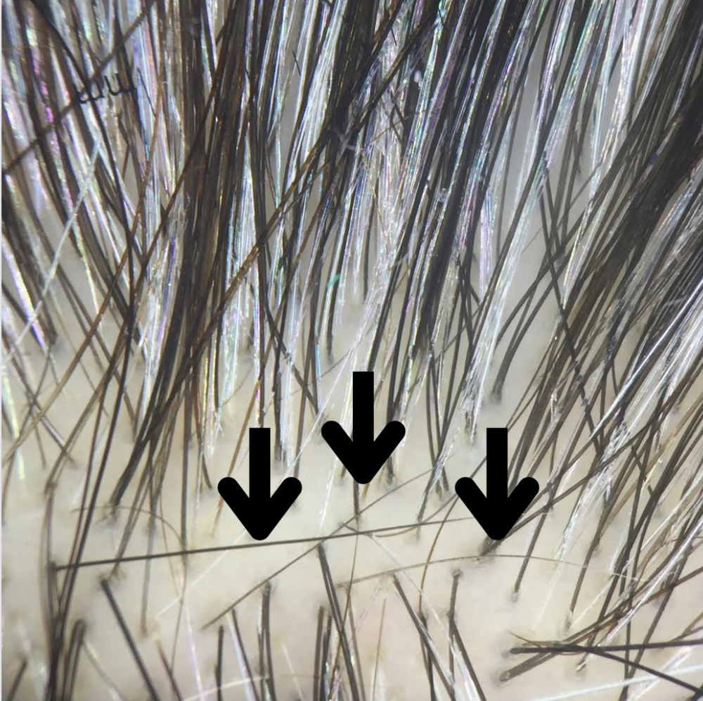 Upright Regrowing Hairs in a Background of Anisotrichosis Clues to AGA