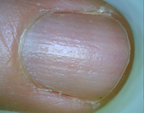 Nail Pitting in Individuals with Alopecia Areata — Donovan Hair Clinic