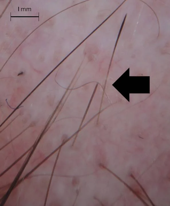 4 mm "exclamation mark" hairs in a patient with alopecia areata