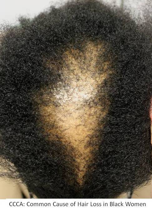 Hair Loss in Black Women: CCCA — Donovan Hair Clinic