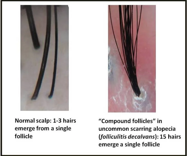 Multiple Facial Hairs In One Follicle