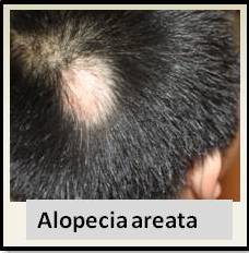 Alopecia areata - an autoimmune condition — Donovan Hair Clinic